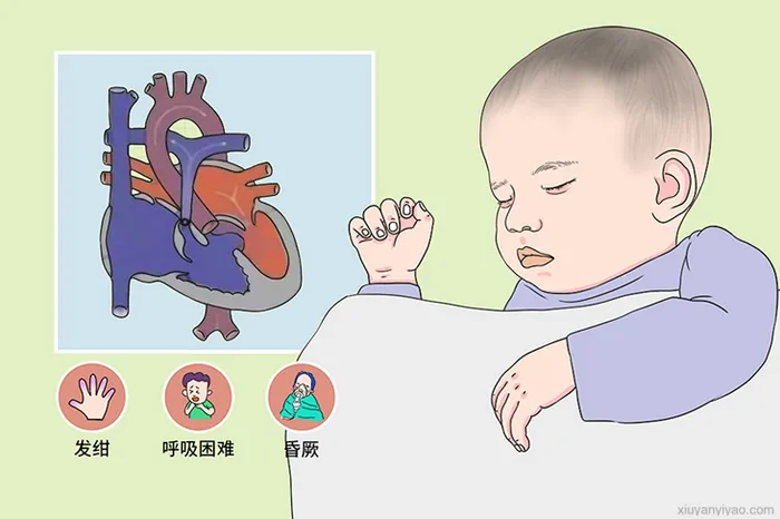  法洛四联症到底能不能治愈？中药效果怎么样？