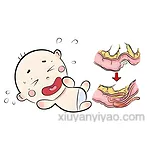 深度解析：疝气究竟需不需要手术治疗？