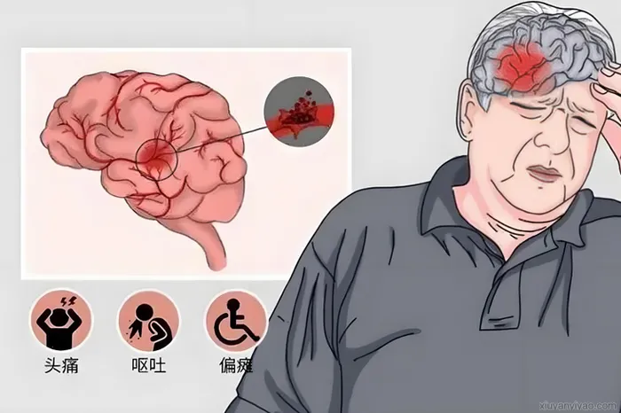 解析脑梗死发病原因,为健康敲响警钟
