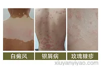 深度解析：白癜风使用希格玛紫外线光疗仪的可行性